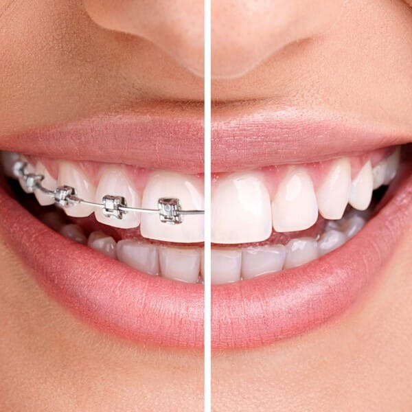 معایب و مزایای الاینر شفاف یا اینویزالاین
