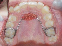 انواع ابزارهای ارتودنسی