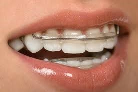 انواع درمانهای ارتودنسی