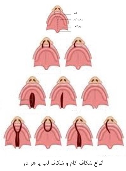 لب شکری یا شکاف کام و لب