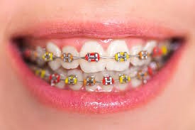 انواع ابزارهای ارتودنسی