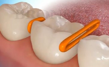 انواع ابزارهای ارتودنسی