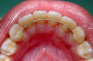انواع ابزارهای ارتودنسی