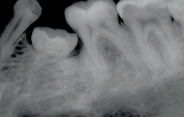 دندان فک جوش یا انکیلوز