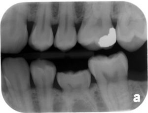 دندان فک جوش یا انکیلوز