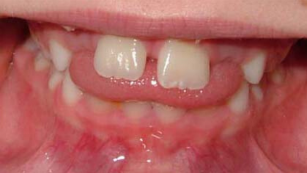 تانگ تراست فشار زبان به پشت دندانها