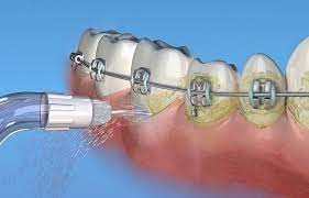 نخ دندان کشیدن در ارتودنسی