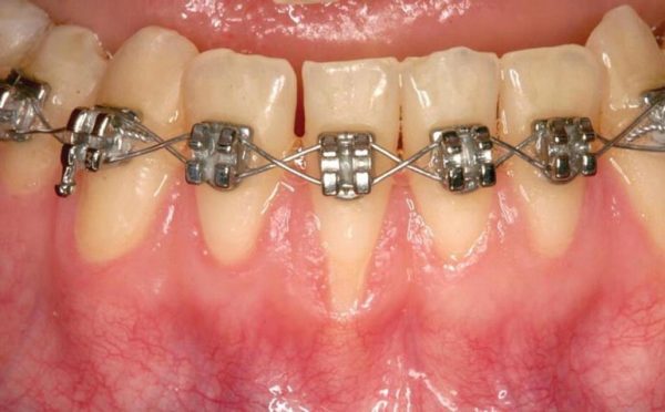 حساسیت دندانی حین درمان ارتودنسی
