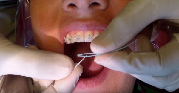نخ دندان کشیدن با براکت ارتودنسی