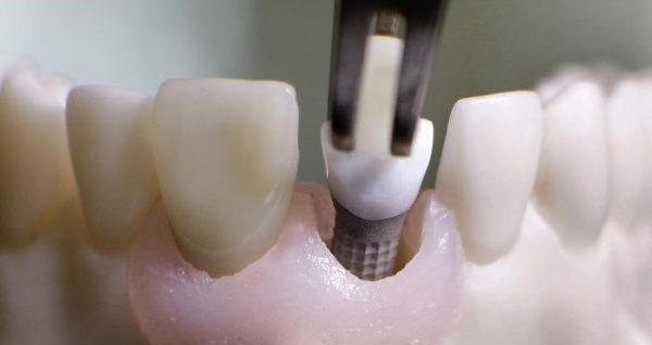 عفونی شدن ایمپلنت دندانی