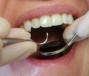 حساسیت دندان بعد از جرمگیری