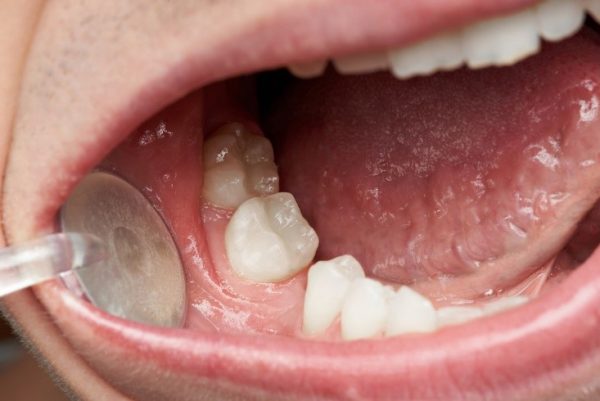 خطرات کشیدن دندان