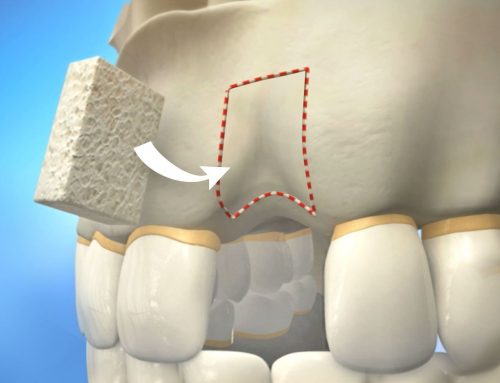 پیوند استخوان قبل از کاشت ایمپلنت های دندانی