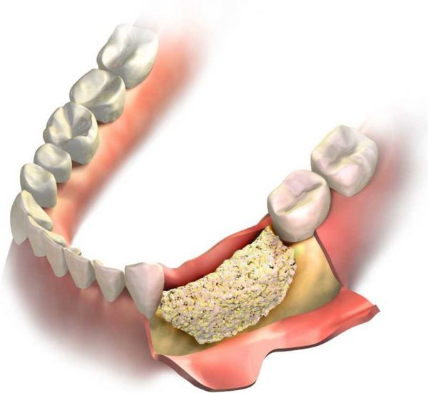 پیوند استخوان قبل از کاشت ایمپلنت دندانی