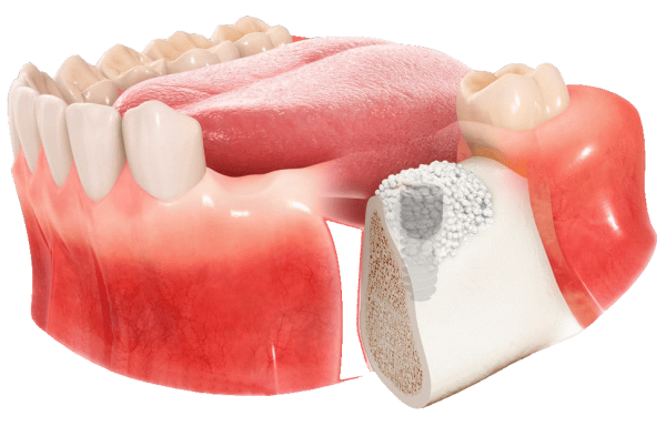 پیوند استخوان قبل از کاشت ایمپلنت دندانی