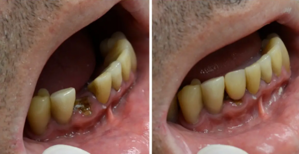  ایمپلنت دندانی یک روزه یا فوری