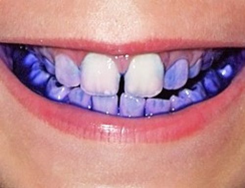 قرص آشکار کننده پلاک دندان چیست؟