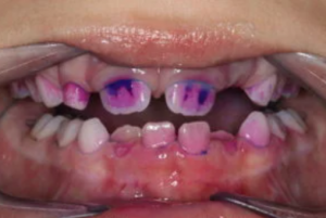 قرص آشکار کننده پلاک دندان 