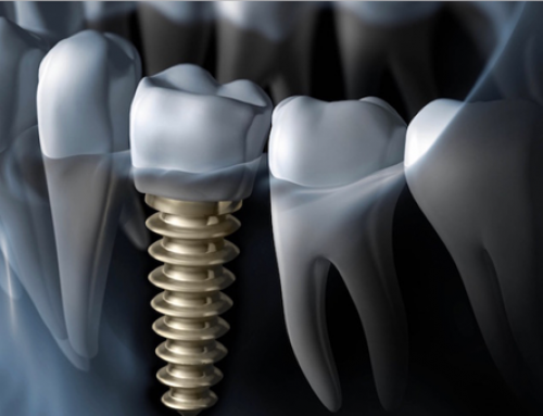 علت شکست ایمپلنت های دندانی و راهکارهای مقابله