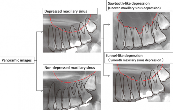 تأثیر سینوس ماگزیلاری روی جابجایی دندان 