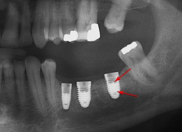  شکست ایمپلنت دندانی
