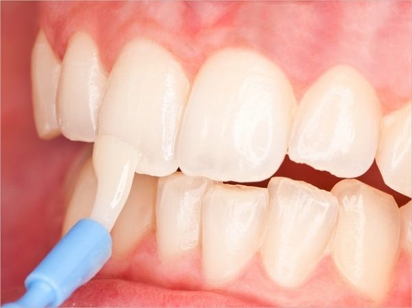  معدنی سازی مجدد دندان