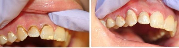  معدنی سازی مجدد دندان