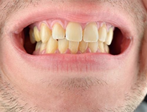 آیا با اتصالات ارتودنسی نامرئی می توان دندان ها را سفید کرد؟