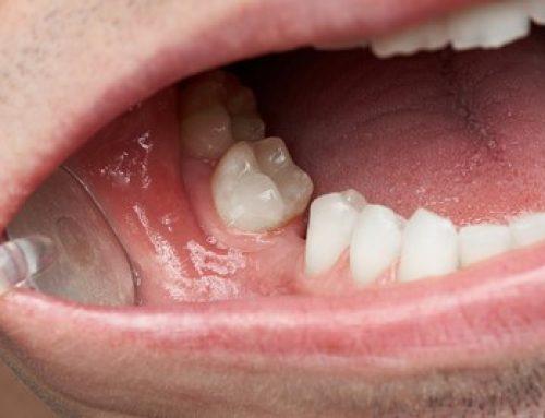 آیا لثه ها بدون دندان هم عفونی می شوند؟