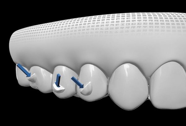 نقش تری ارتودنسی نامرئی در سفید کردن دندان 