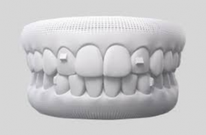 نقش تری ارتودنسی نامرئی در سفید کردن دندان 