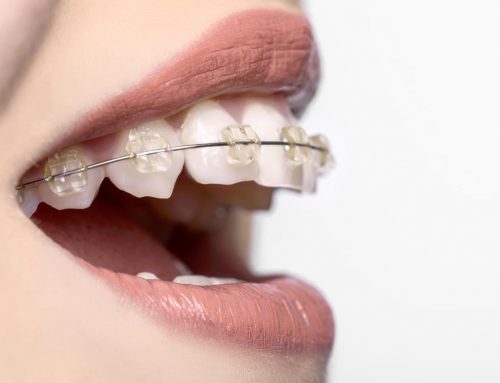 آیا بریس ها می توانند دندان های بلند را به داخل لثه فرو ببرند؟