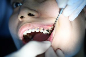 بریس ها و حرکت دندان