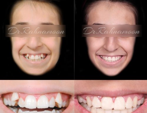 درمان نامرتبی شدید دندان های فک بالا و پایین