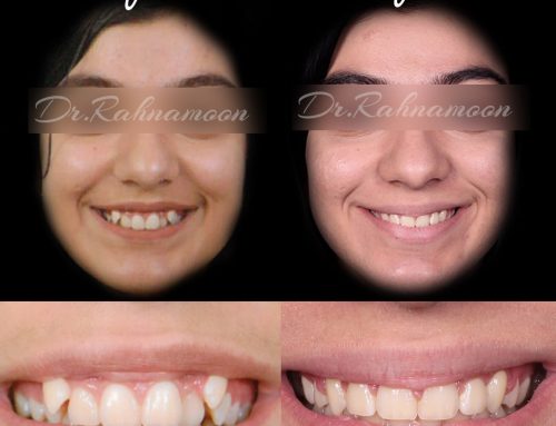 درمان نامرتبی دندان و اصلاح لبخند