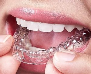 هر دندانپزشکی می تواند با الاینرهای شفاف شما را درمان کند