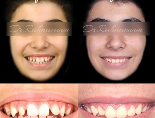 بستن فضای بین دندانی با ارتودنسی ثابت