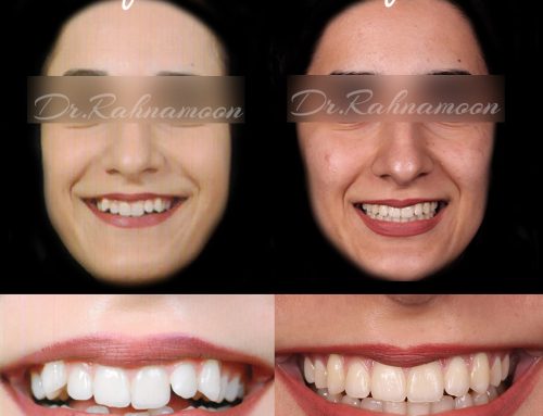 اصلاح لبخند و مرتب کردن دندان ها