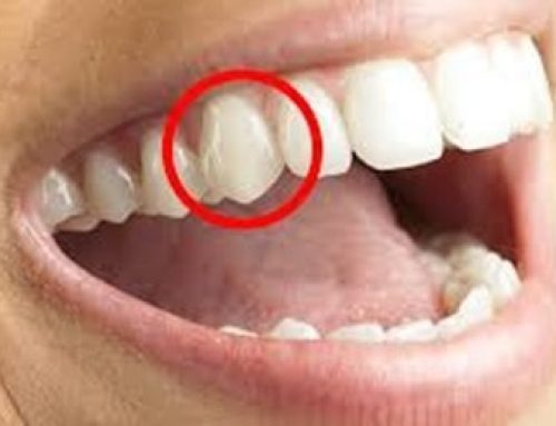 چرا دندان های برخی افراد خیلی نوک تیز هستند؟