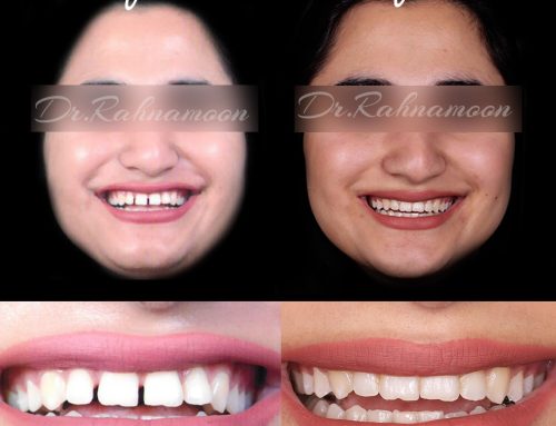 بستن فضای بین دندانی و اصلاح لبخند
