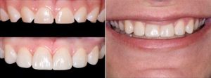 پیامدهای سلامتی دندان های کوچک