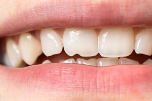 چه چیزی باعث شکستن دندان های من می شود؟