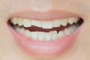 دندانپزشکان چگونه شکستگی دندان را تشخیص می دهند؟
