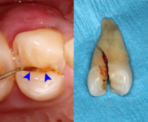 چگونه از شکستگی دندان جلوگیری کنیم؟