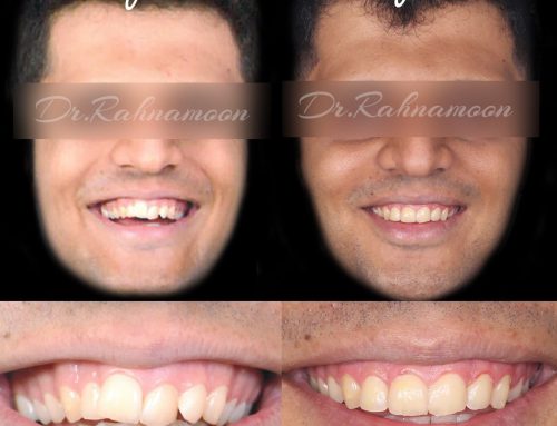 اصلاح انحراف خط وسط دندانی
