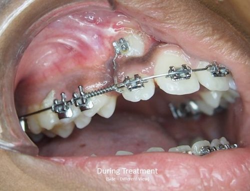 آیا ارتودنسی می تواند به دندان های نهفته کمک کند؟