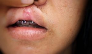 چگونه بریدگی ها و زخم های دهان خود را درمان کنیم؟