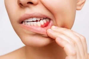 آیا محافظ های دندان شبانه می توانند به لثه ها آسیب بزنند؟