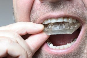 آیا محافظ دندان شبانه می تواند باعث تحلیل لثه ها شود؟