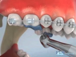 مزایای بایت رایزر یا بالا برنده بایت